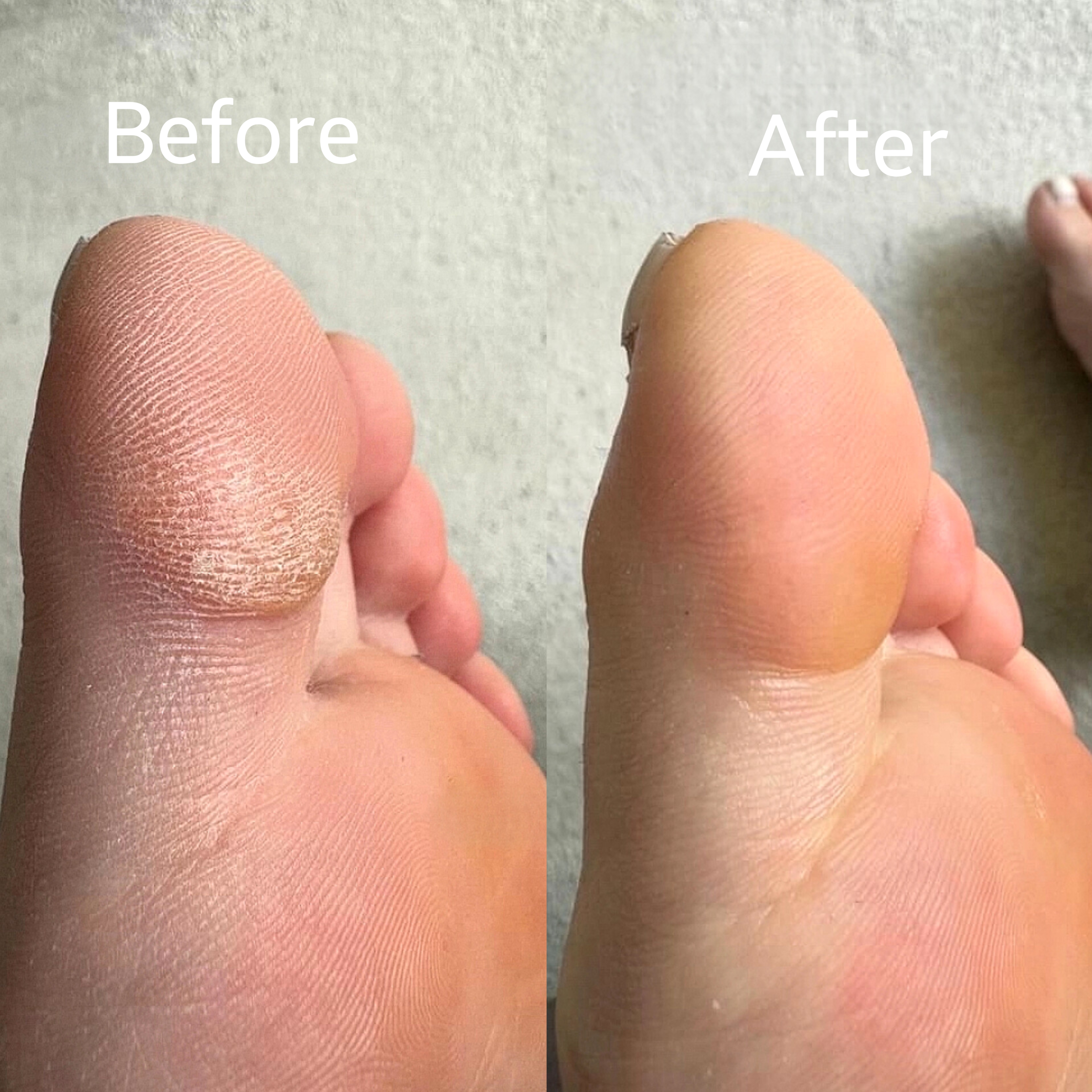 کرم ترک پا وکالی 🌱